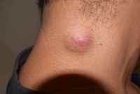 Attachment for 9 gejala kelenjar getah bening di leher yang perlu kamu perhatikan